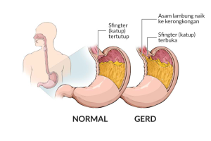 Tips untuk Menjaga Agar Lambung Tetap Sehat